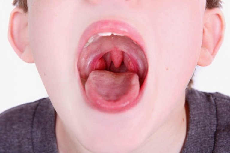 Trẻ bị viêm amidan thường do vi khuẩn, virus gây lên.png